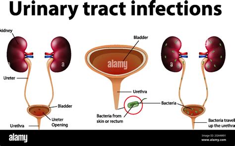 Informative Illustration Of Urinary Tract Infections Stock Vector Image