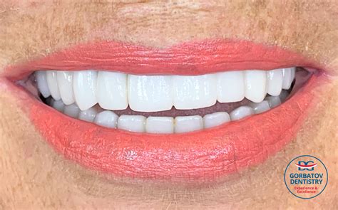 Before And After Gorbatov Dentistry Your Dentist In Hollywood Sunny Isles Hallandale Miami