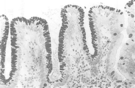 Duodenal Biopsy Specimen Showing Extensive Area Of Gastric Metaplasia