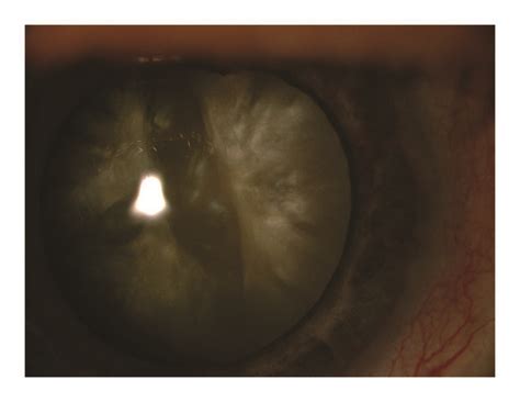 Color anterior segment picture: (a) right eye, whitish cataract and... | Download Scientific Diagram