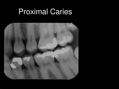 Ppt Radiographic Interpretation Of Dental Caries Powerpoint