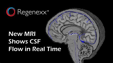 Using MRI to Measure CSF Flow in Patients with CCJ Instability - Regenexx®