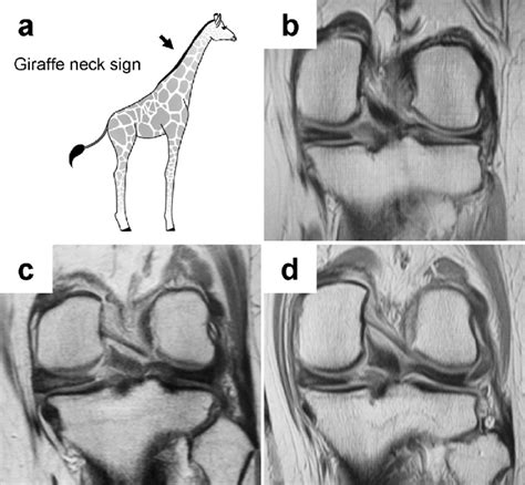 Representative Giraffe Neck Signs A An Illustration Of A Giraffe