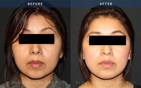 Hispanic Rhinoplasty Archives Radiance Surgery Aesthetic Medicine