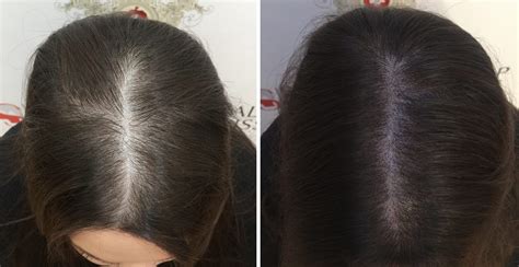 La Micropigmentation Capillaire Chez Les Femmes Scalp Swiss