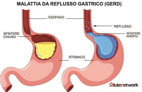 Acidit Di Stomaco Rimedi Casalinghi Per Un Sollievo Immediato