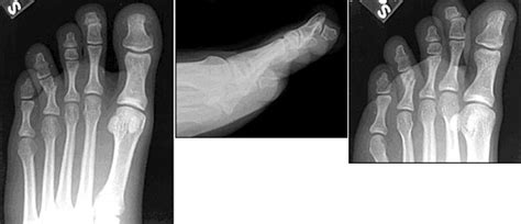 Evaluation And Management Of Toe Fractures Aafp