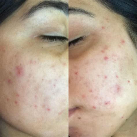 [acne] Incurable steroid induced acne?? Persistent for 9 months— Please ...