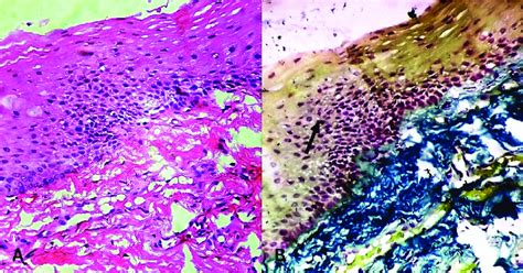 (a) Photomicrograph showing oral epithelial dysplasia (hematoxylin and ...