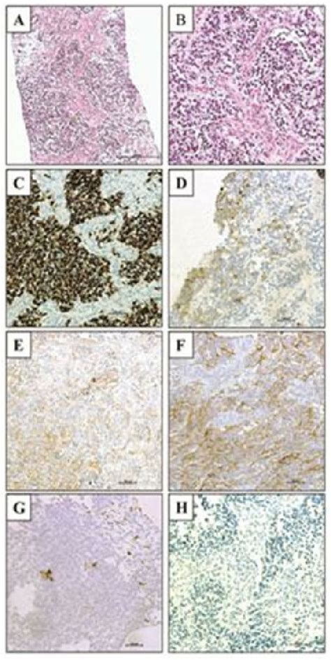 Histologic Features Of Desmoplastic Small Round Cell Tumor Hematoxylin