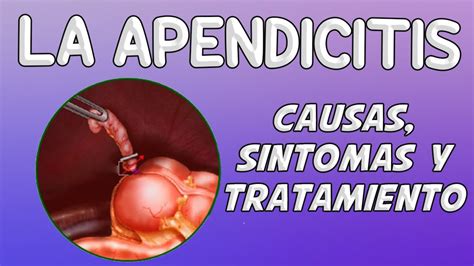 LA APENDICITIS Causas síntomas diagnóstico y tratamiento YouTube