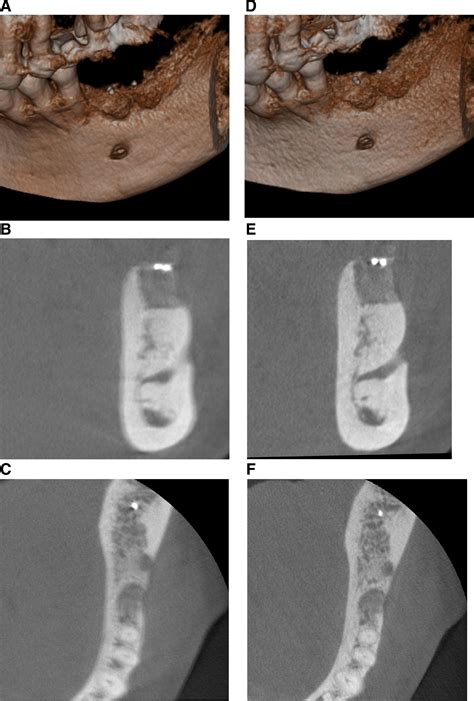 Patient Motion Image Artifacts Can Be Minimized And Re Exposure Avoided By Selective Removal Of