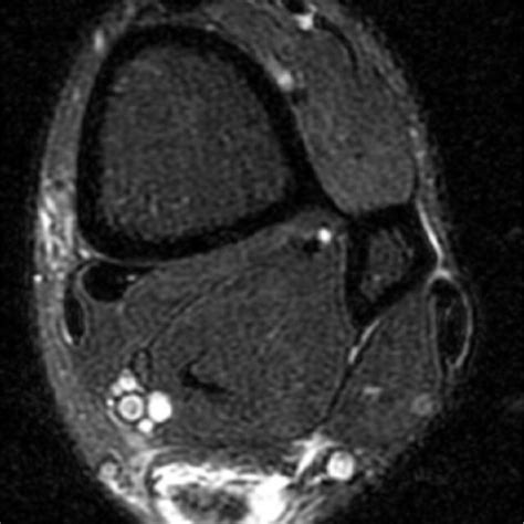 Rupture of the peroneus brevis tendon (MRI oblique axial view). | Download Scientific Diagram