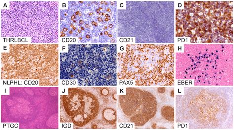 Diagnostic Boundaries Surrounding Nlphl A D T Histiocyte Rich Large Download Scientific