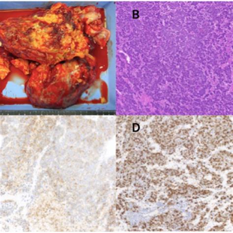 Gross Finding Of Ovarian Tumor A Small Cell Carcinoma Cells With A