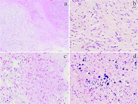 Photomicrographs Of The Surgical Specimen With Hematoxylin And Eosin