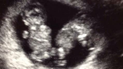 Twin Ultrasound: What All Women Pregnant With Twins Need To Know - About Twins