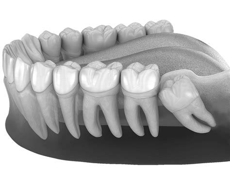 Wisdom Teeth Post Op Oral Surgeon In Marietta Ga