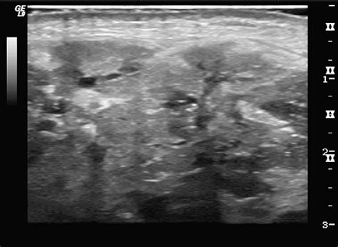 Parotid Gland Ultrasound Measurement