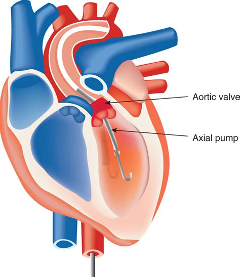 Ecmo And Ventricular Assist Devices Anesthesia Key