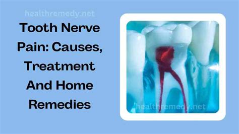 Tooth Nerve Pain: Causes, Treatment And Home Remedies