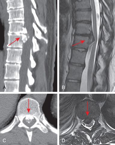 Posterior Longitudinal Ligament Herniation