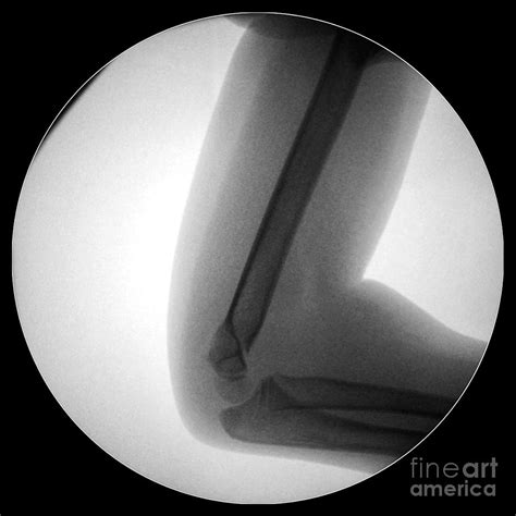 Broken Elbow, X-ray Photograph by Science Photo Library - Fine Art America