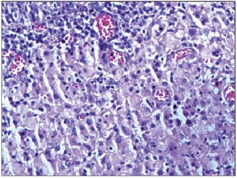 Figure From Xanthogranulomatous Cystitis And Bilateral Ureteral