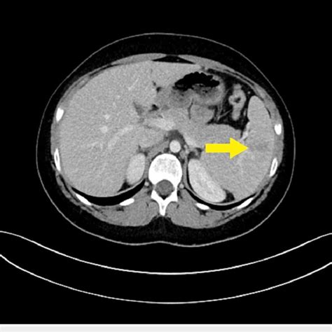 Axial View Of Contrast Enhanced Computed Tomography Of Abdomen