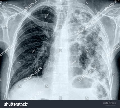 Thoracic Trauma Over 387 Royalty Free Licensable Stock Photos