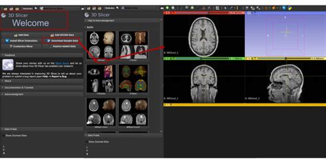 Manual Segmentation Of The Human Choroid Plexus Using Brain MRI