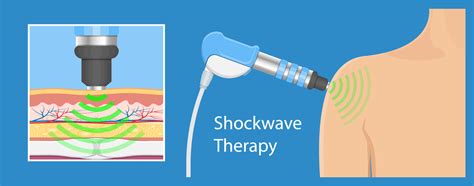 Shockwave Therapy Explore Health Wellness