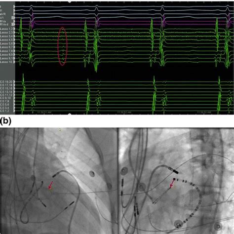 Ablation Catheter In The Anterior Lvot With The Retrograde Approach And