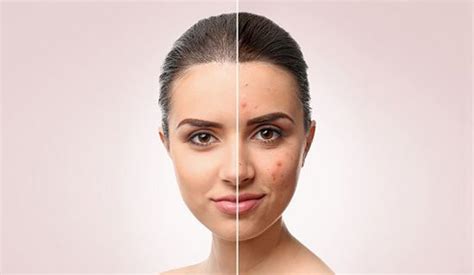 What Causes Of Adult Acne And How To Treat It