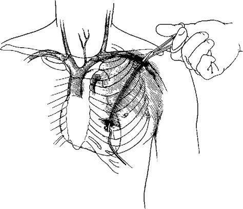 Figure 1 From A Technique For Tunneling Central Venous Catheters