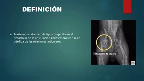 Luxación Congenita De Cadera Ppt