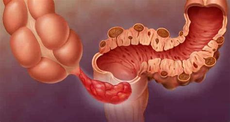 13 Síntomas De La Diverticulitis ¿qué Es Causas Y Señales Salud