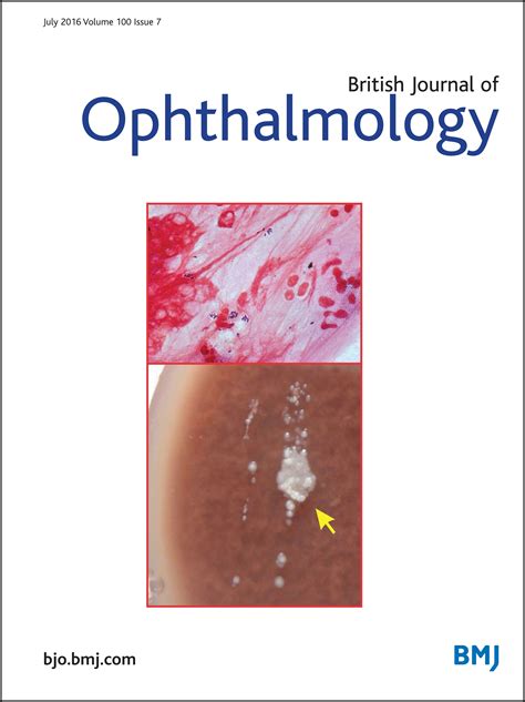 Corynebacterium Spp As Causative Agents Of Microbial Keratitis British Journal Of Ophthalmology