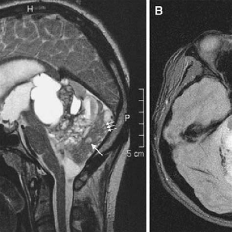 Radiological Features Of Rosette Forming Glioneuronal Tumor Rgnt