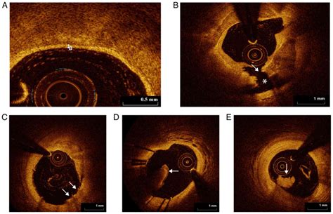 Advantages And Prospects Of Optical Coherence Tomography In