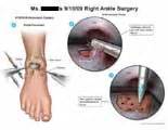 AMICUS Illustration Of Amicus Surgery Ankle Portal Arthroscopic Scope