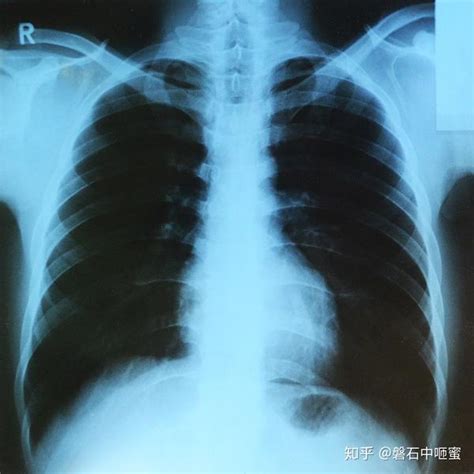 X射线 X Ray 知乎