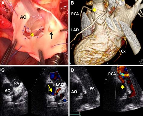 Value Of Stress Transesophageal Echocardiography In An Asymptomatic