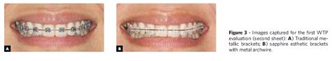 Scielo Brasil Esthetic Perception And Economic Value Of Orthodontic Appliances By Lay