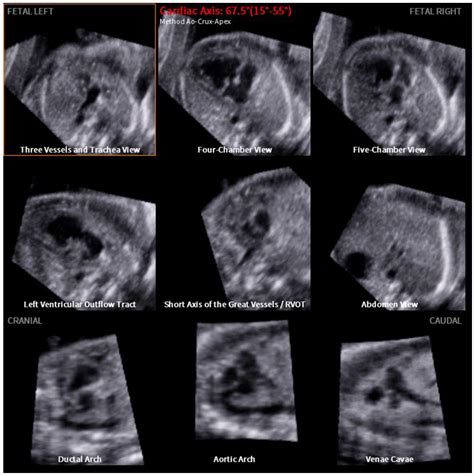 Jcm Free Full Text Semi Automatic Measurement Of Fetal Cardiac Axis