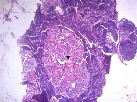 Frontiers Warthin Like Papillary Thyroid Carcinoma A Case Report And