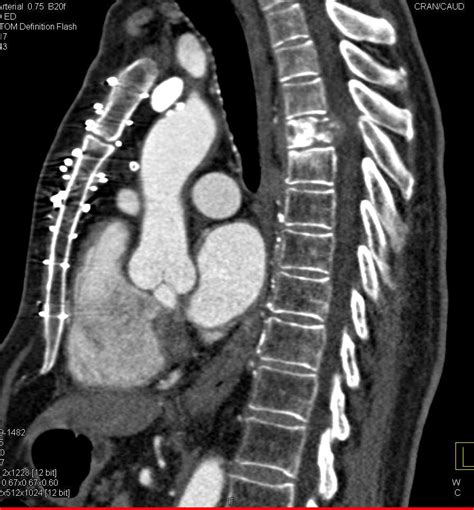 Osteomyelitis T Spine Musculoskeletal Case Studies Ctisus Ct Scanning