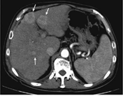 11 Hepatocellular Carcinoma | Radiology Key