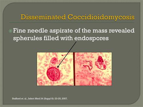 Ppt Disseminated Coccidioidomycosis Powerpoint Presentation Free