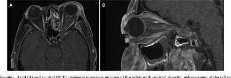 Figure 2 From Orbital Apex Syndrome From Bacterial Sinusitis Without